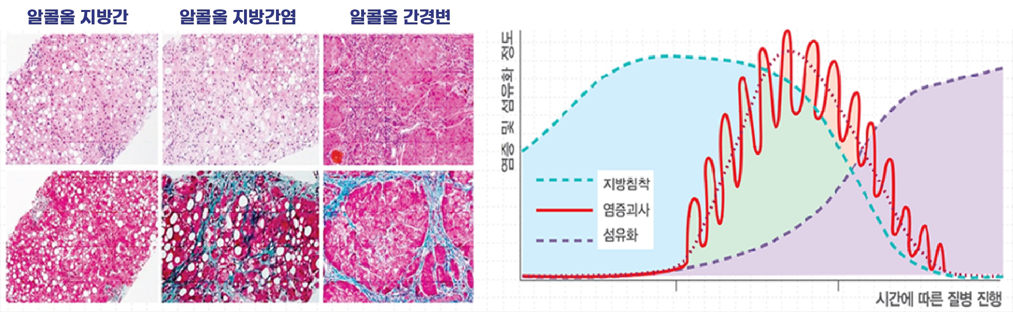 알코올성 간질환